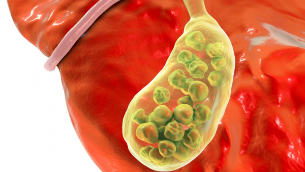 Πέτρες στη χολή-Χολολιθίαση.